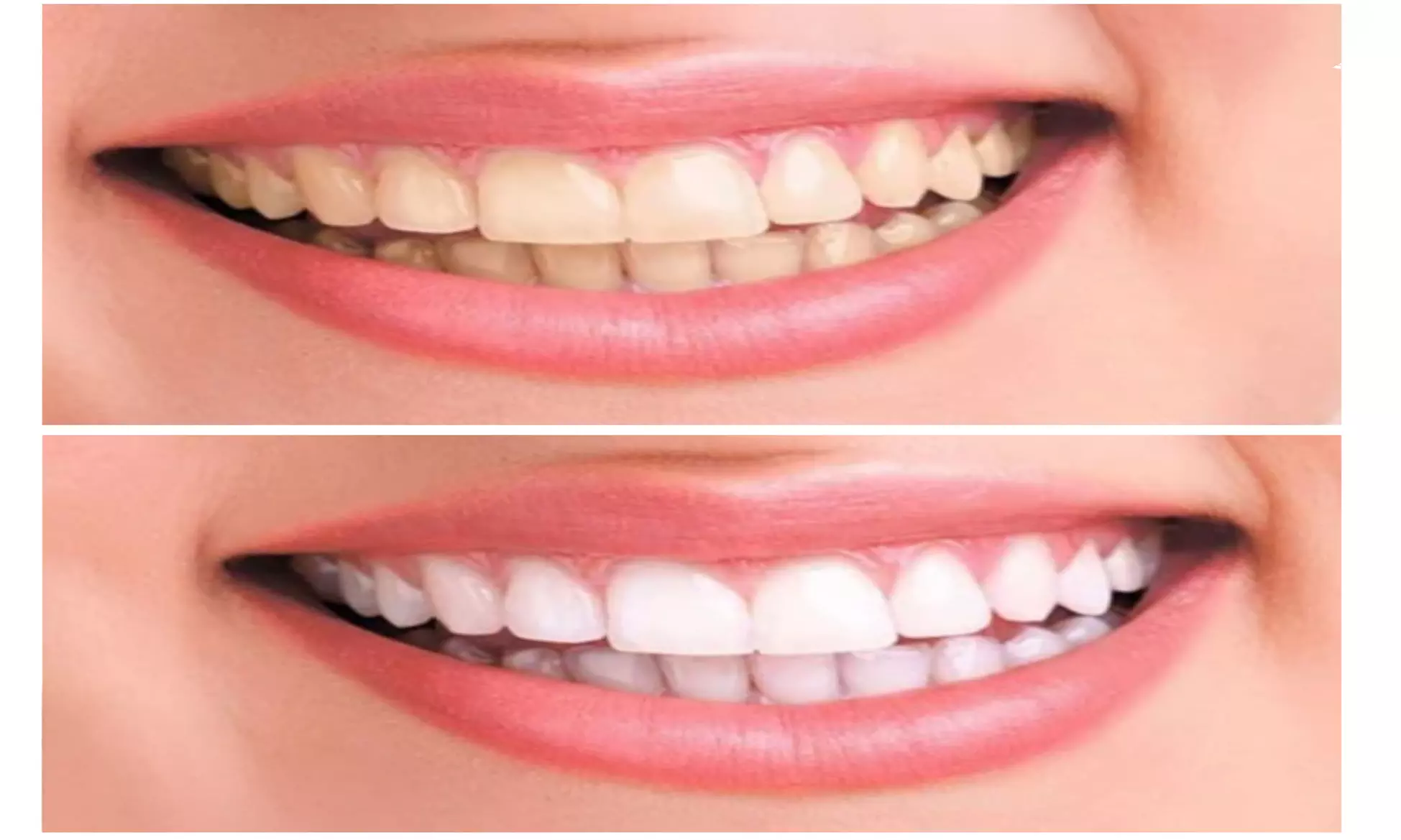 Professional 3D Teeth Whitening Kit w Remineralization Gel: 1 & 2 pack