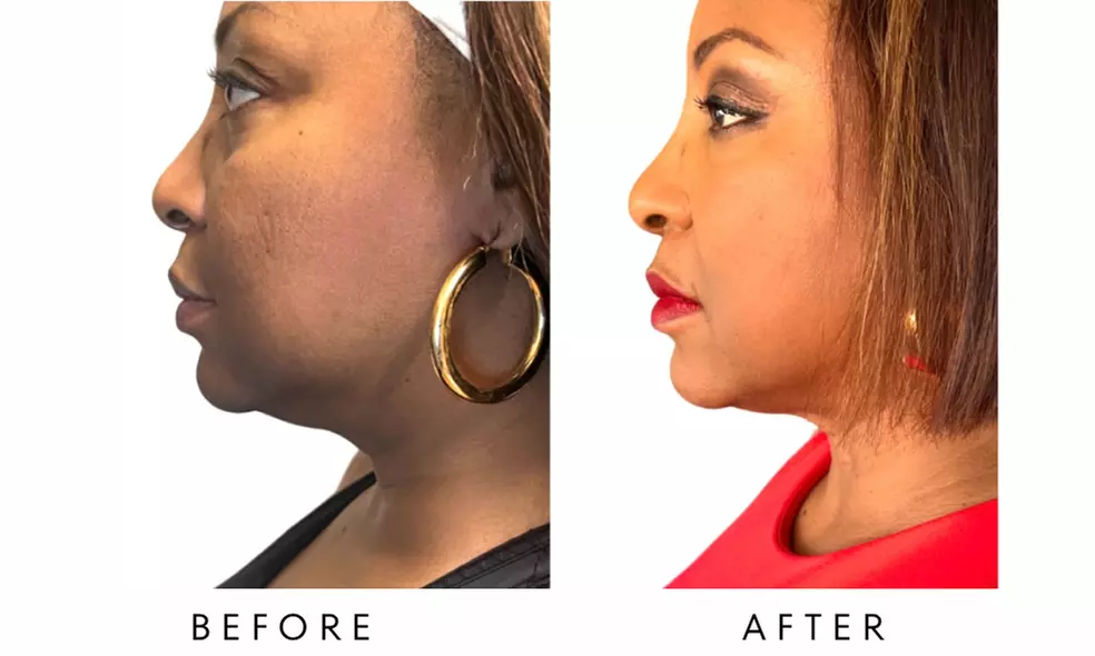 FACE-TITE - Face/Neck Tightening & Contour Lift at Your Sculpt Studio
