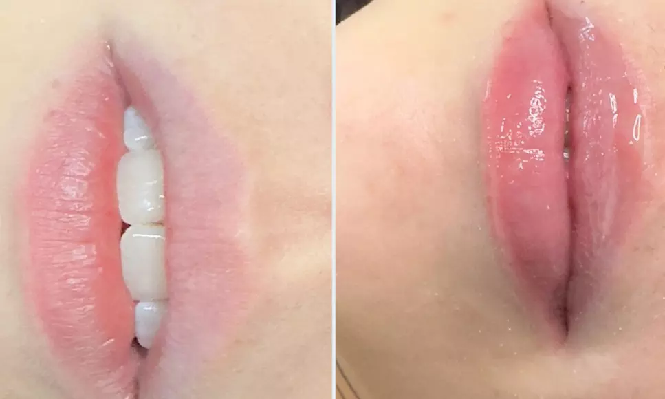 Get One or Three Sessions of Hydra Gloss Lips with Hydrapen