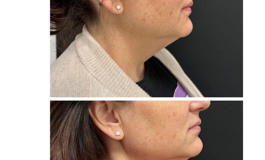 Image 7: Enhance Beauty with 1.5 CC Radiesse or 1.0 CC Hyaluronic Acid Filler