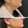 Image 7: Enhance Beauty with 1.5 CC Radiesse or 1.0 CC Hyaluronic Acid Filler