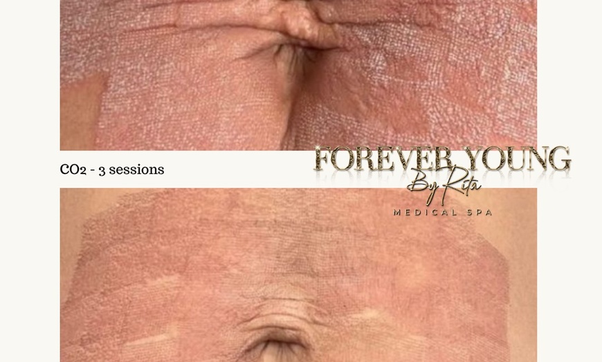 Image 7: Light or Intense Mode CO2 Laser Resurfacing Treatment for Full Face