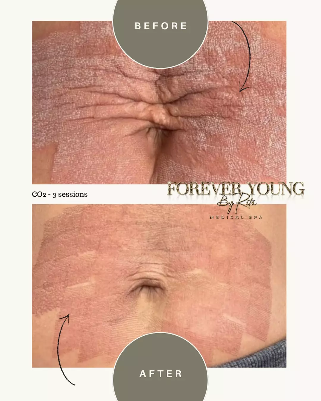 One Light or Intense Mode CO2 Laser Resurfacing Treatment for Full Face at Forever Young by Rita (Up to 55% Off)