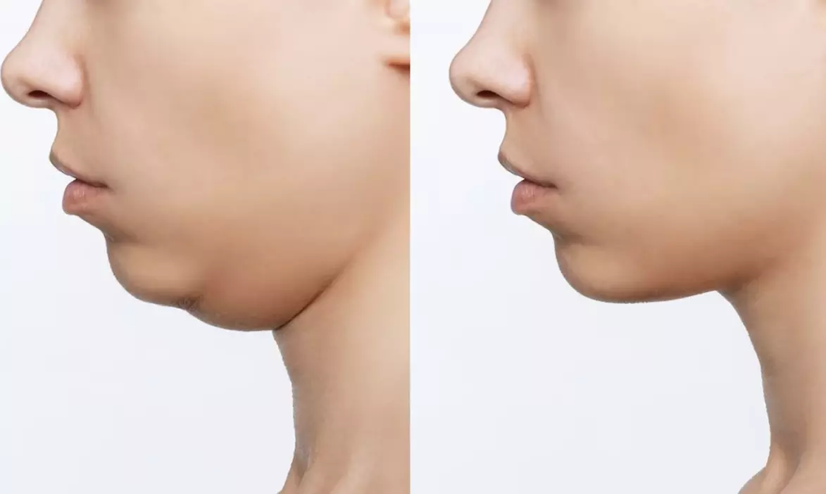 1 of 3x dubbele kin-cryolipolysebehandeling van 40 minuten