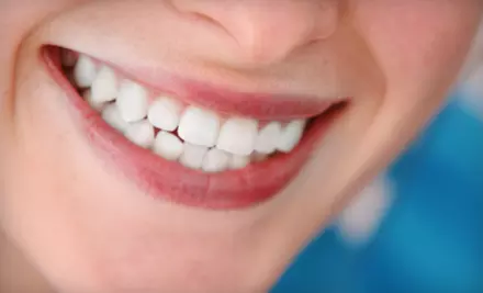 In-Office or Take-Home Teeth Whitening from SmileLABS - Primary Image