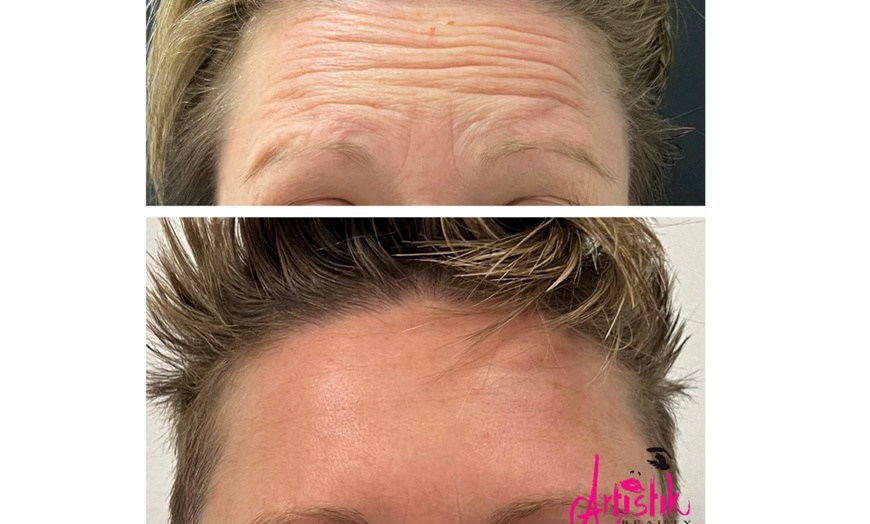 Image 4: Revitalize Your Look with Xeomin at Artistik Beauty