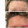 Image 4: Revitalize Your Look with Xeomin at Artistik Beauty