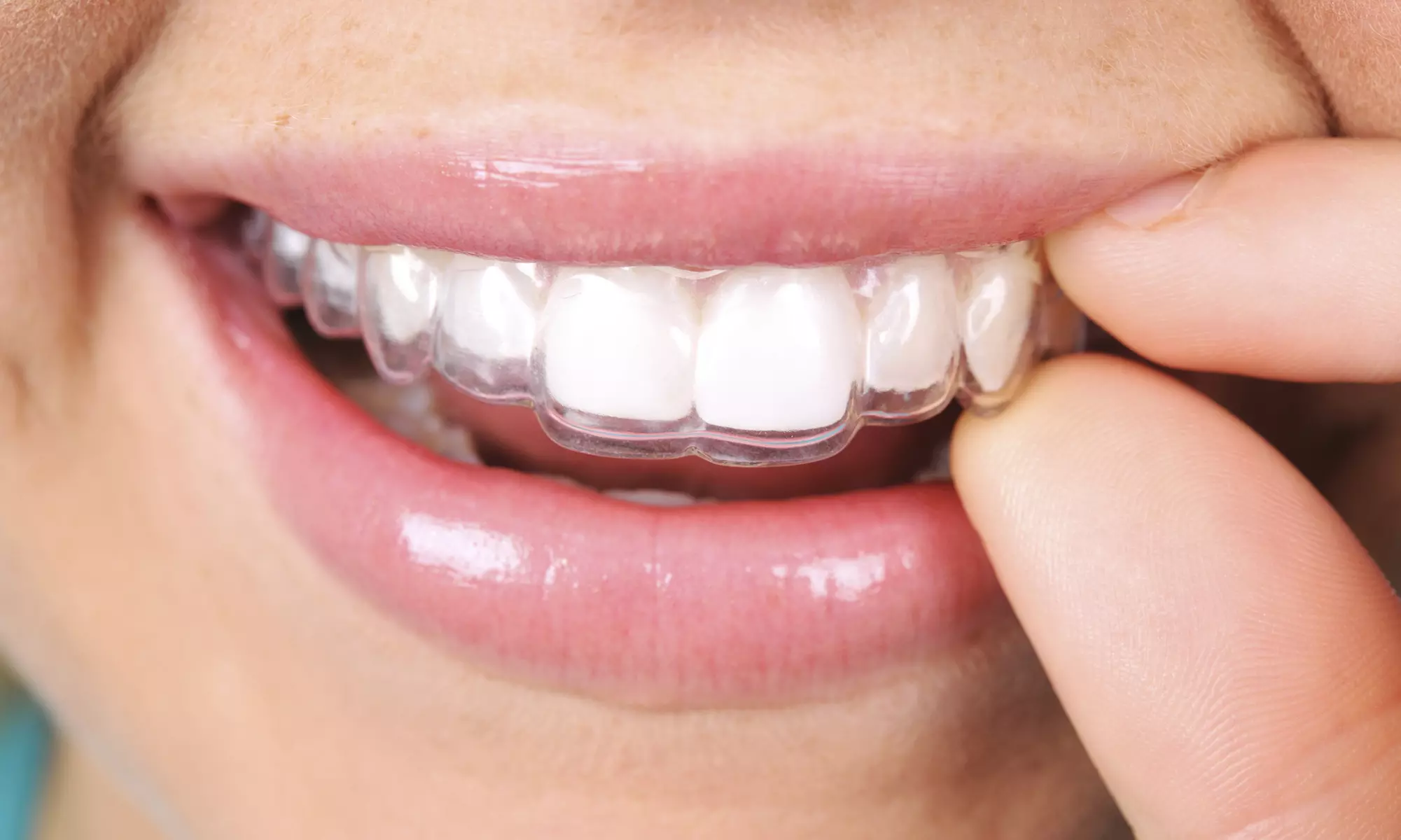 $166 for $1,775 Worth of Invisalign at Kentucky Orthodontics & Invisalign - Primary Image