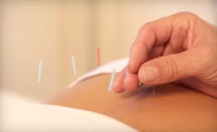 $30 for a 30-Minute Consultation and a 60-Minute Acupuncture Session at The Acupuncture Clinic ($120 Value) - Primary Image