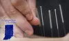 $35 for a 90-Minute Acupuncture Session with Consultation from Acupuncture of Indiana ($185 Value)
