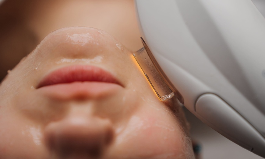 Image 1: 1 o 3 sesiones de IPL facial para revitalizar o atenuar manchas