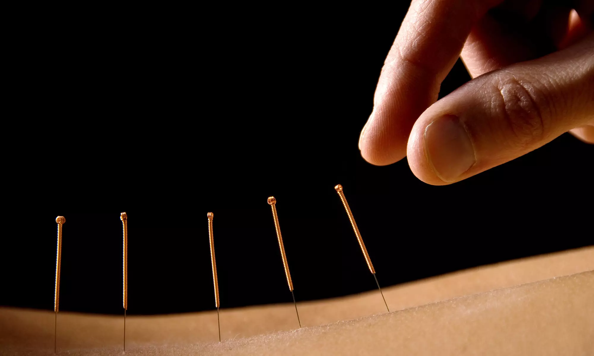 Nutrition-Assessment Packages with Acupuncture at Duvé Wellness Center (Up to 50% Off). Three Options Available. - Primary Image