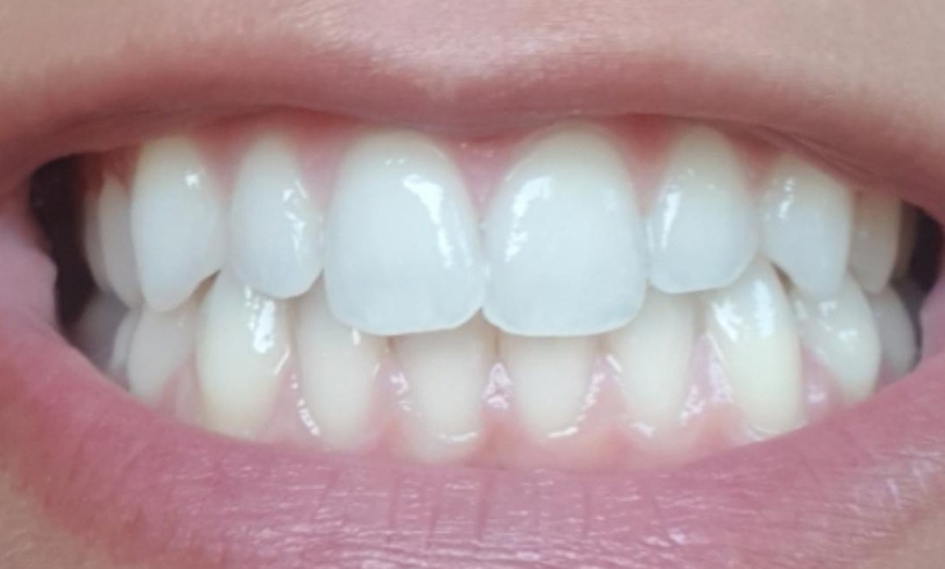 Image 2: Limpieza bucal con ultrasonidos y blanqueamiento led en Dentales