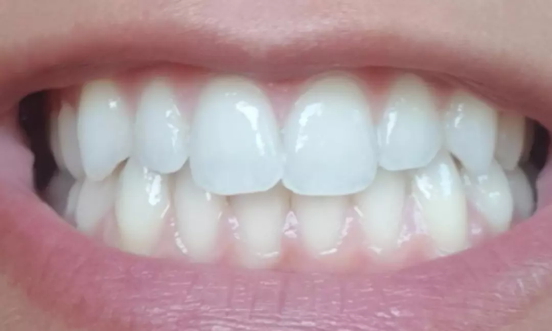 Limpieza bucal con ultrasonidos y blanqueamiento led en Dentales