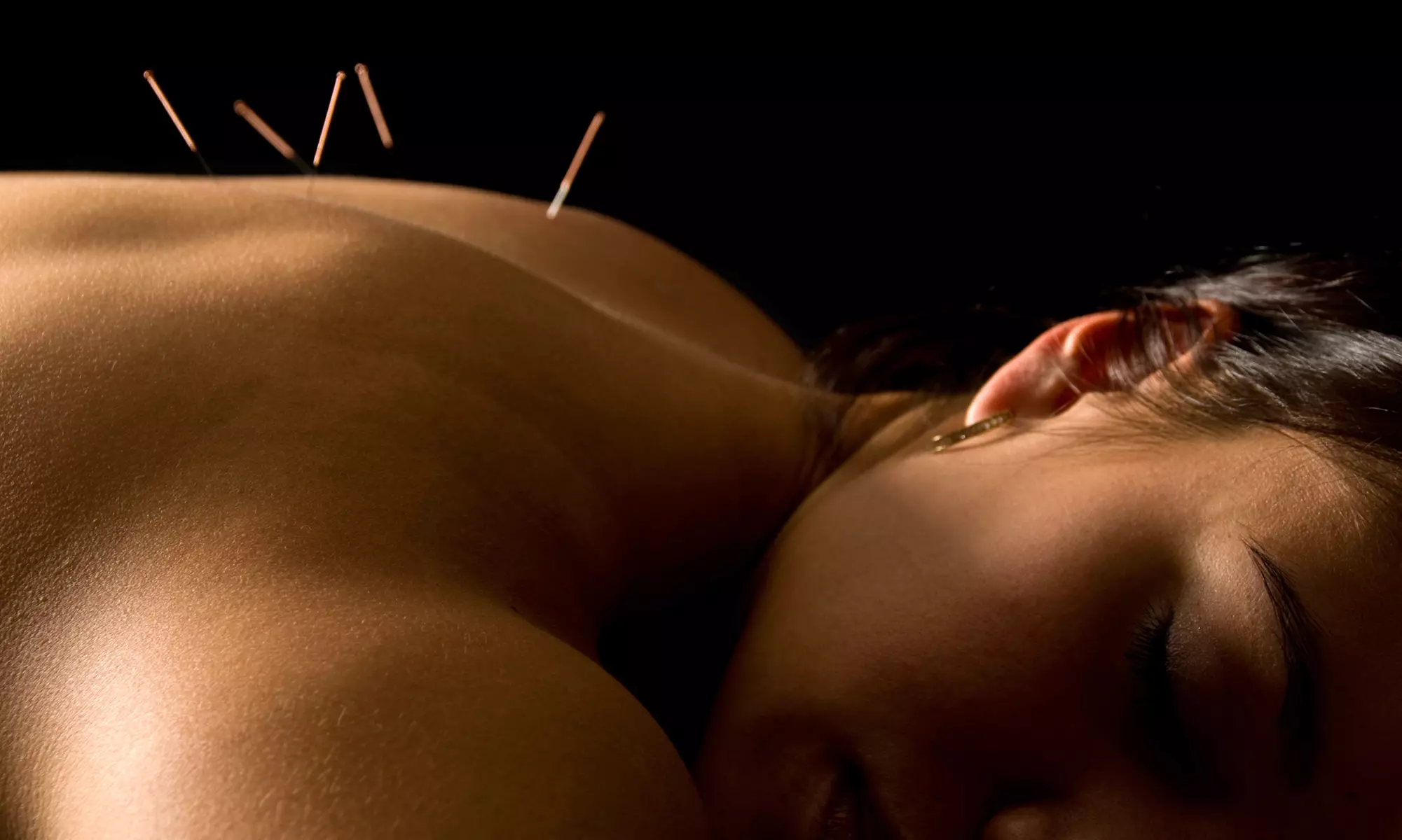 One or Three 60-Minute Acupuncture Sessions from Nancie Forrest, M.S., L.Ac. (Up to 58% Off) - Primary Image