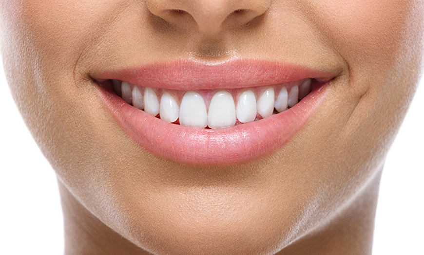 Image 1: Scaling, Cleaning, Polishing and Zoom Laser Teeth Whitening 