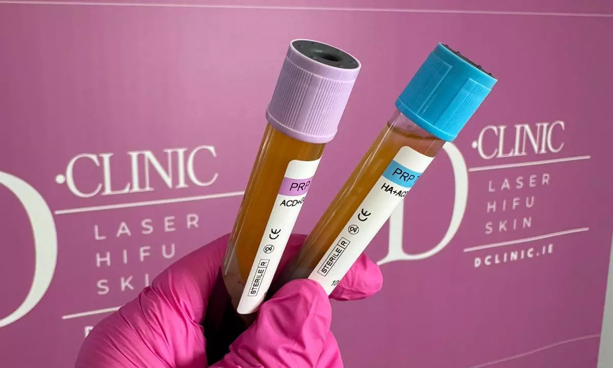 One Clinical PRP Treatment with Biotin and Exosomes