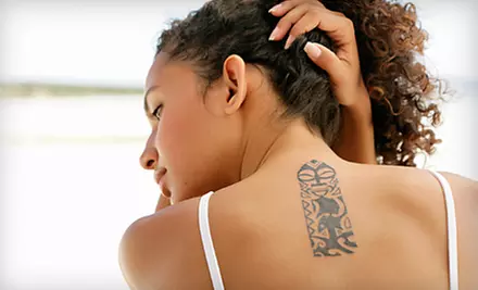 Laser-Tattoo Removal for Small or Large Area at Advanced Laser Clinics in Glendale (Up to 79% Off)  - Primary Image
