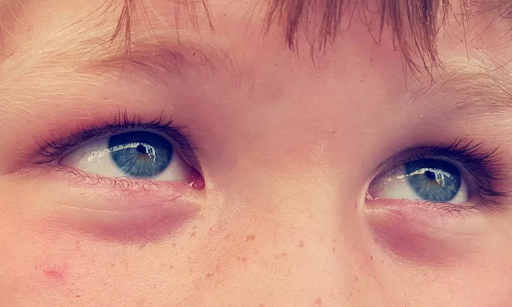 Initial Assessment and One- or Three-Months of Orthokeratology at Optical Revolution - Primary Image