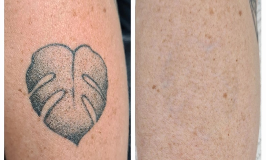 Image 4: Up to 86% Off on Tattoo Removal at Sure Thing Studio
