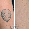 Image 4: Up to 86% Off on Tattoo Removal at Sure Thing Studio