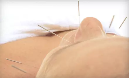 Initial Consultation and One or Two Acupuncture Sessions at Family Clinic of Natural Medicine (Up to 61% Off) - Primary Image