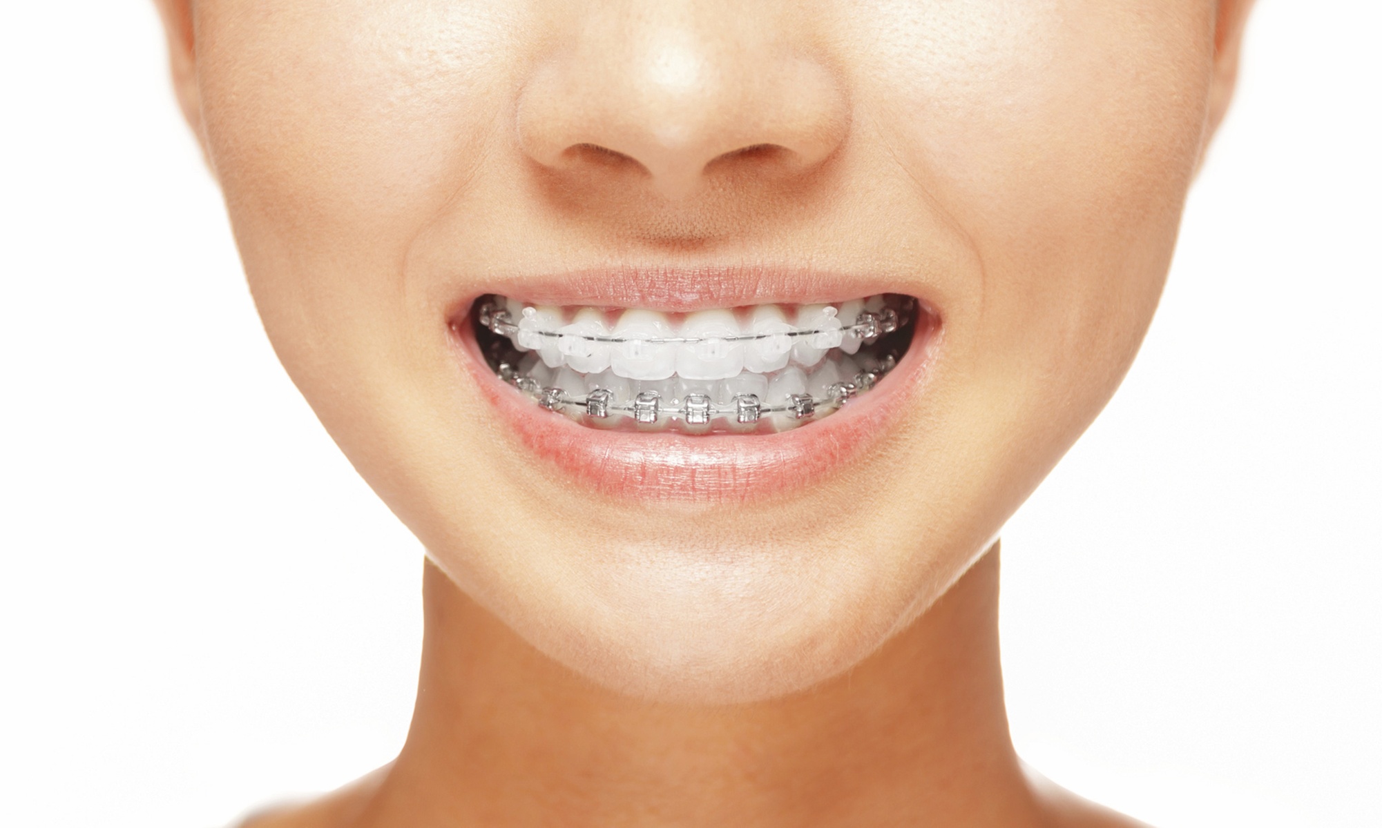 Ortodoncia con brackets metálicos