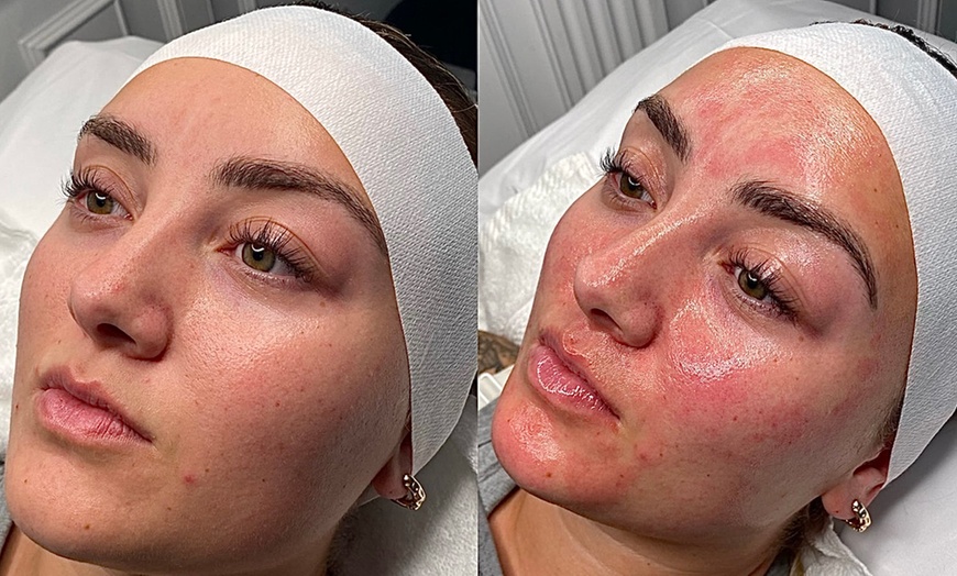 Image 2: Chemical Peels & Facials: VI, BioRePeel, SENSI, Acne and Glass Skin