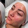 Image 2: Chemical Peels & Facials: VI, BioRePeel, SENSI, Acne and Glass Skin