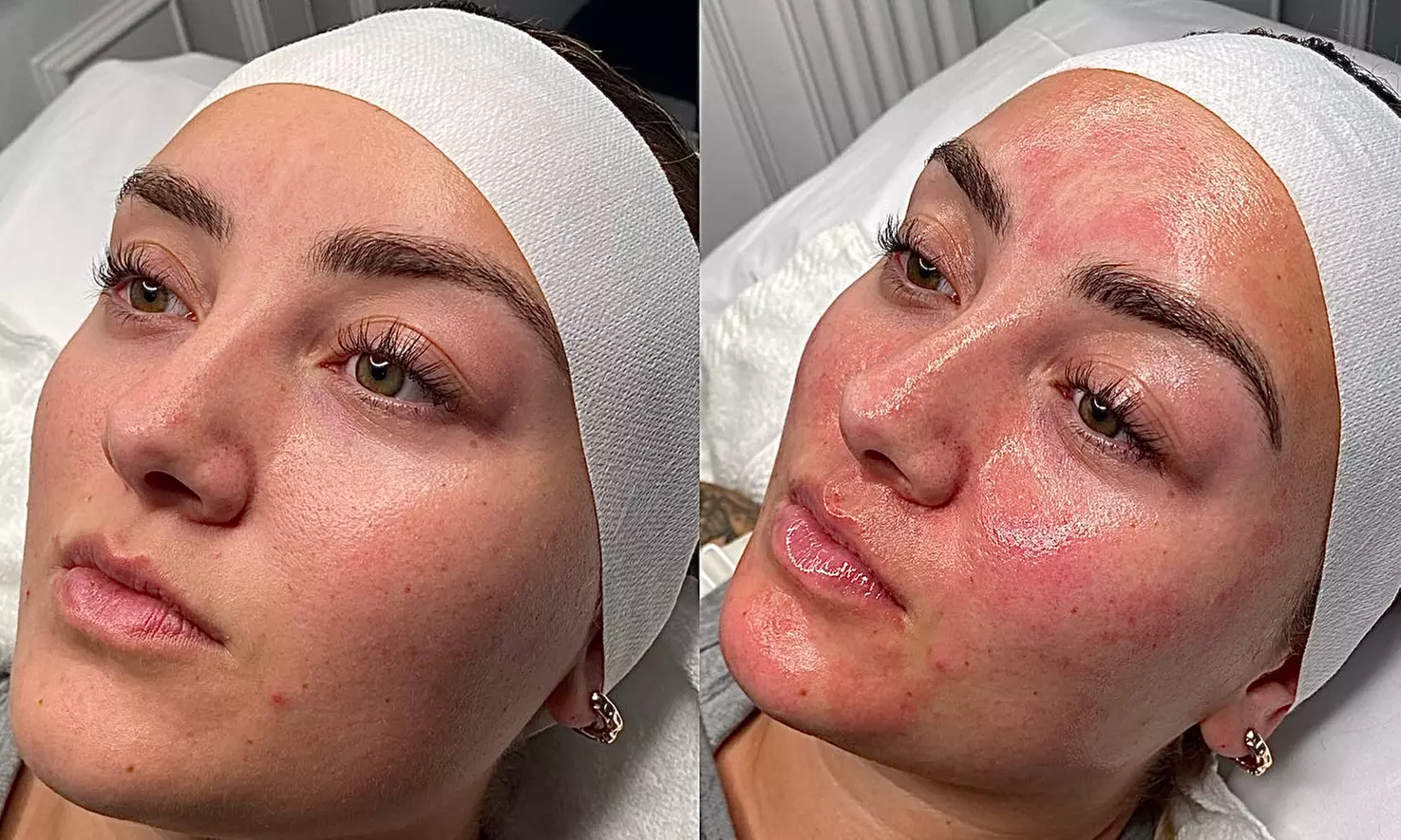 Chemical Peels & Facials: VI, BioRePeel, SENSI, Acne and Glass Skin