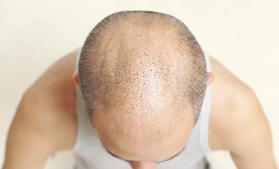 $1,100 for $2,500 Worth of Hair Restoration — DermiMatch - Primary Image