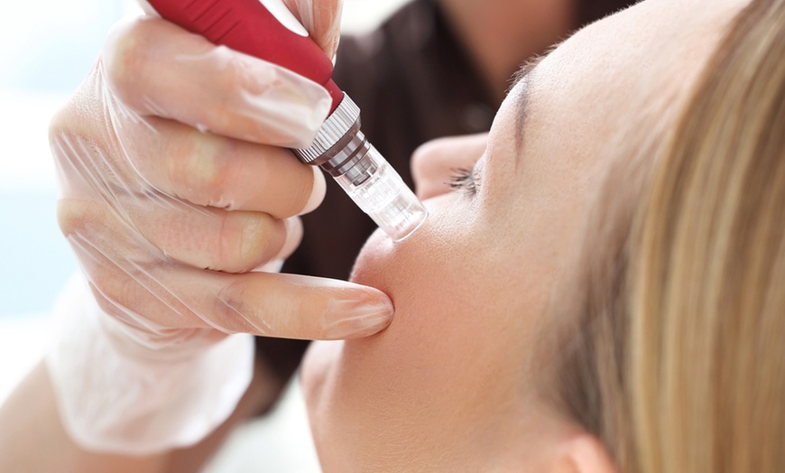 Image 2: Stretch Mark Removal w/ Micordeeling + Carboxytherapy