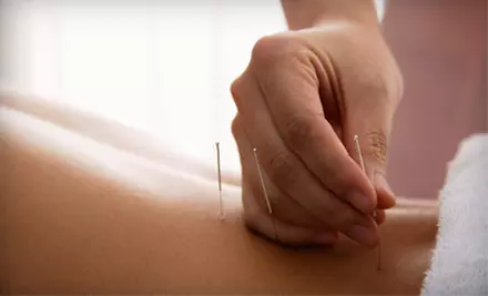 $49 for 60-Minute Acupuncture Treatment and Oriental Medical Exam at Wexford Wellness CARE ($150 Value) - Primary Image