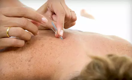 One or Two Acupuncture Sessions at B-Alternative (Up to 70% Off) - Primary Image