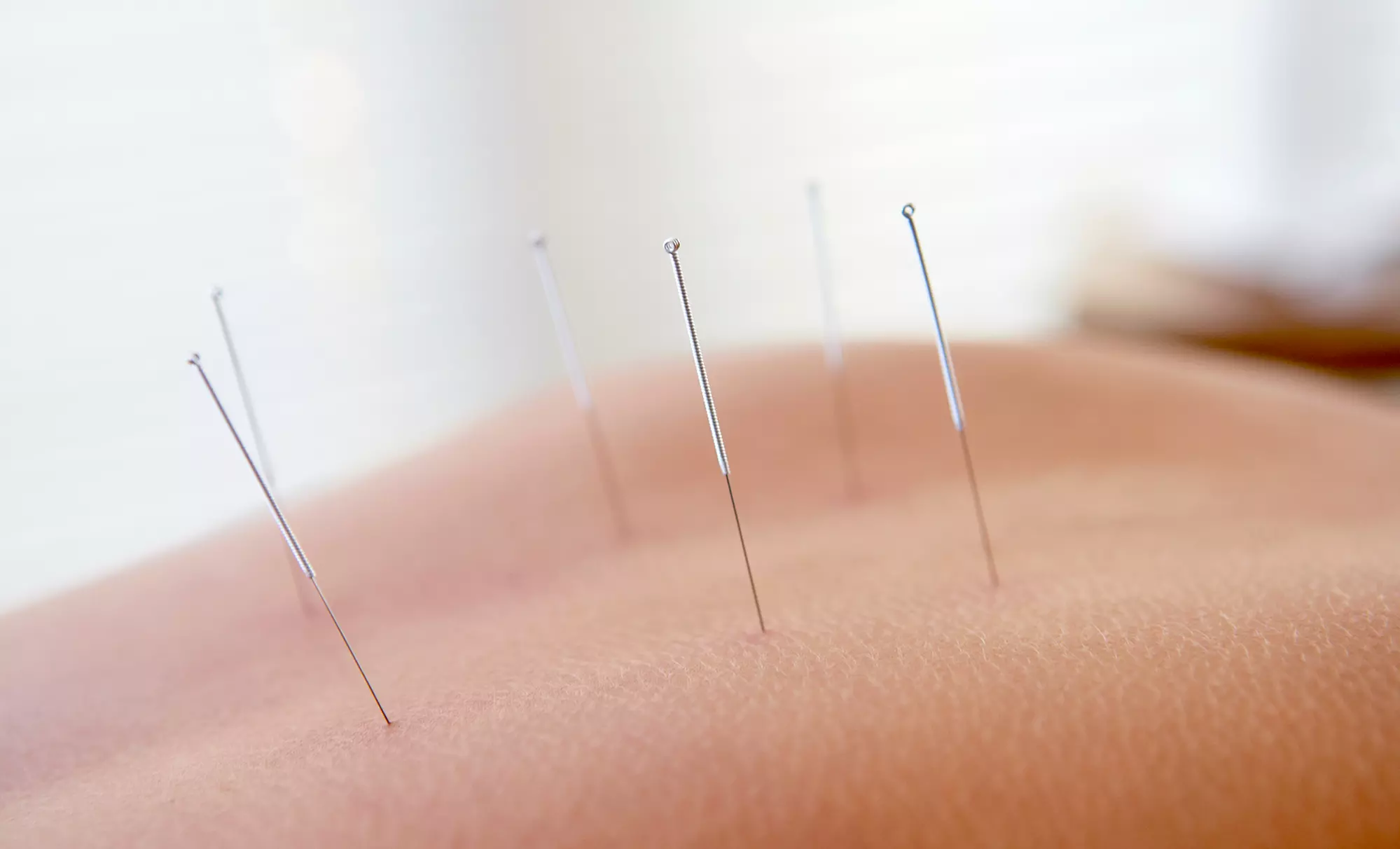 Acupuncture Treatment and Optional $20 Credit Toward Herbal Formulas at Pflugerville Acupuncture (Up to 55% Off) - Primary Image