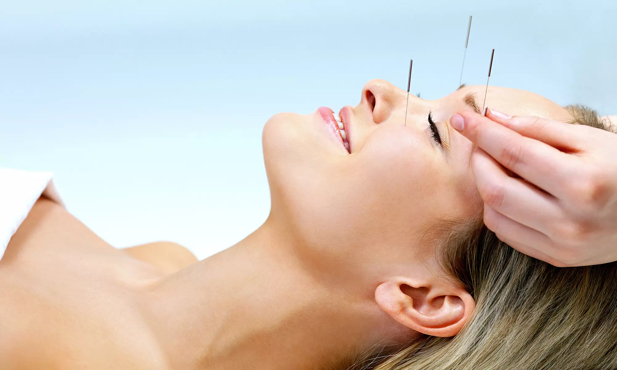 One, Two, or Three Acupuncture Sessions at Lifetree Clinic (Up to 74% Off) - Primary Image