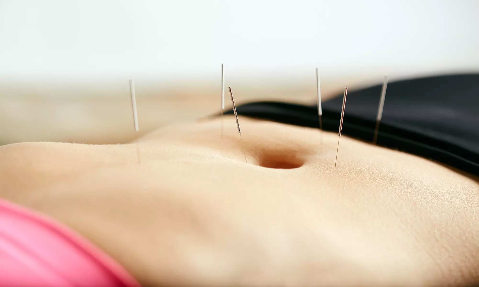 One or Three 60-Minute Acupuncture Sessions at AcuBlossom Clinic (Up to 63% Off) - Primary Image