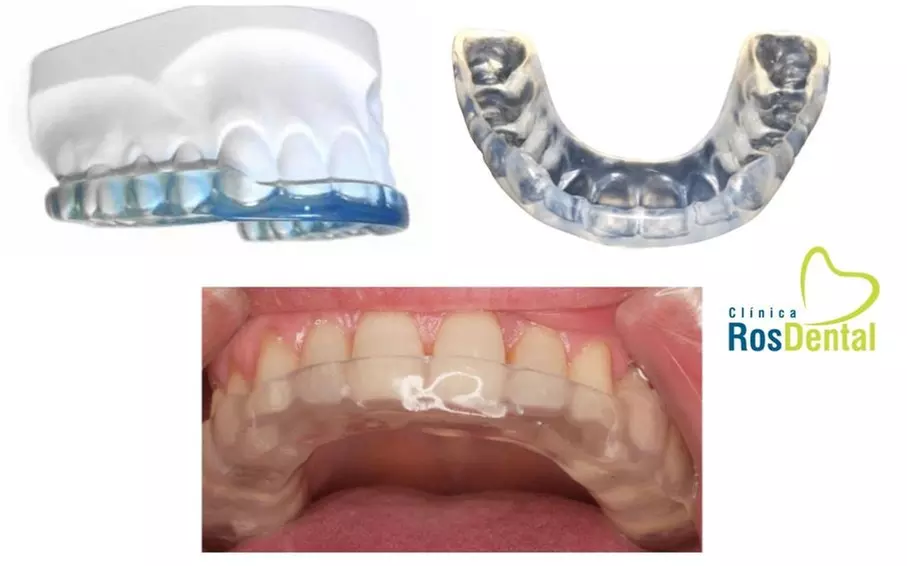 Blanqueamiento dental led