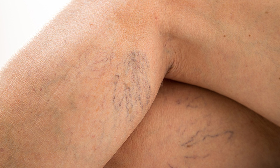 Discover Non-Invasive Spider Vein Consultation and Treatment