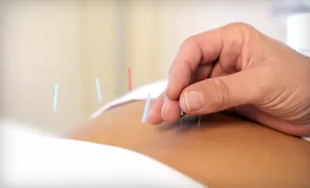 One or Two 60-Minute Acupuncture Sessions at Tigerlily Wellness & Acupuncture (Up to 76% Off) - Primary Image