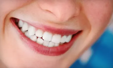 $179 for Teeth-Whitening Treatment ($595 Value) or $59 for a Teeth Cleaning, X-Ray, Exam, and Fluoride Treatment (Up to $300 Value) at So-Well Dental Associates - Primary Image