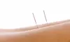 One or Three Acupuncture Sessions at Acupuncture and Herbal Remedies (Up to 74% Off)