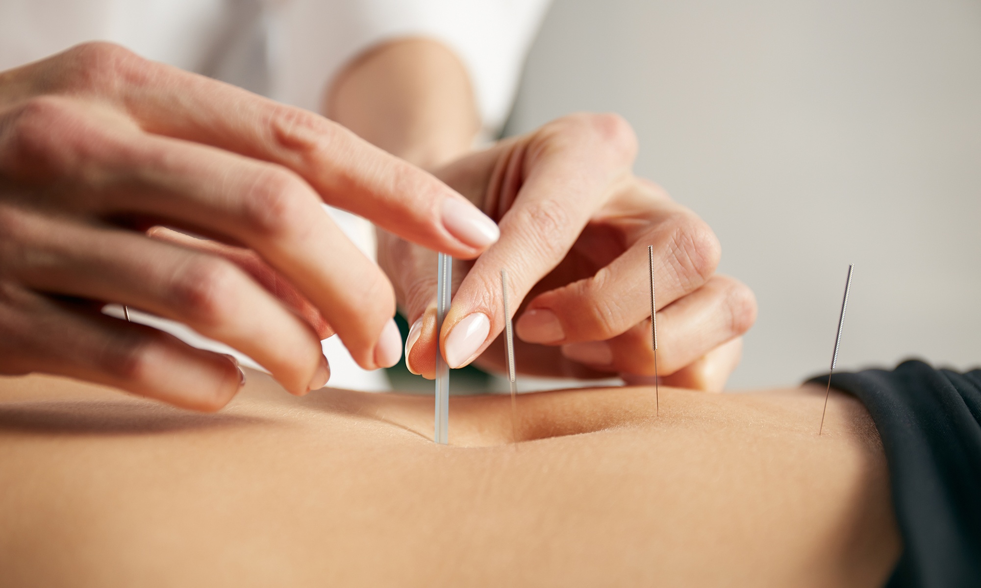 Choose from One, Two, or Three 45-minute Acupuncture Sessions