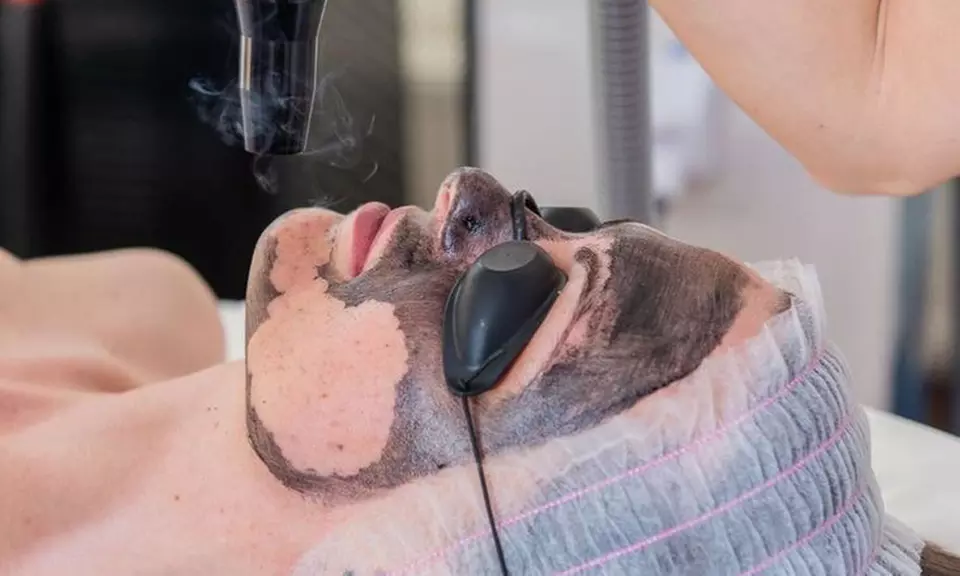 Renueva tu piel con un peeling Hollywood en Beauty Maragall