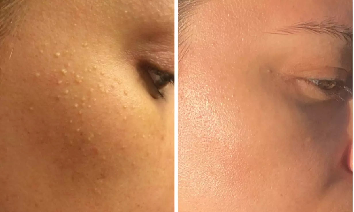 Clear Complexion Acne & Signature Facials for Radiant Skin