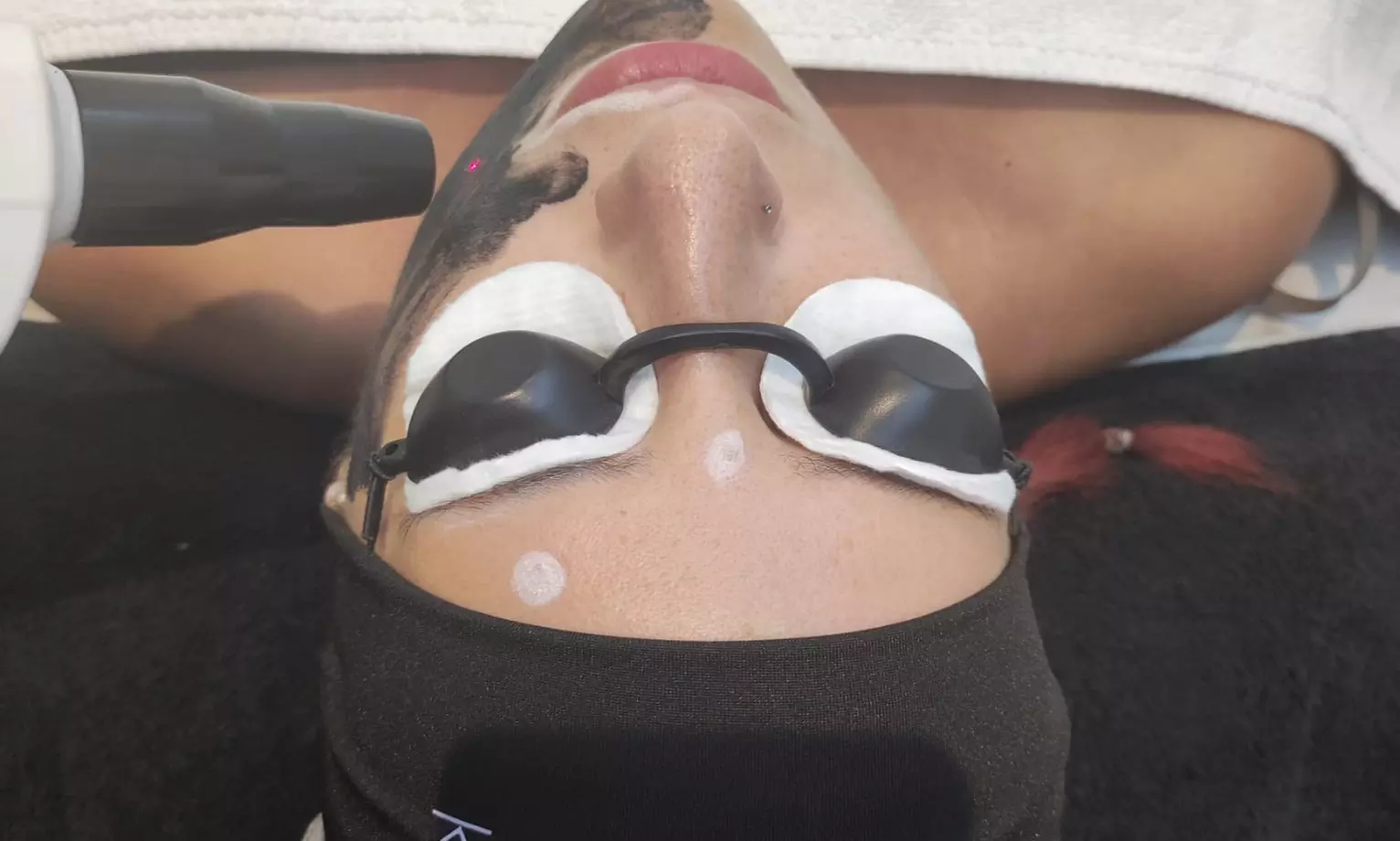 Tratamiento facial con láser en Sapphira Prive Madrid centro