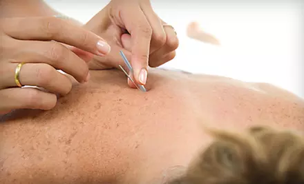 $49 for an Acupuncture Spa Package at Blue Lotus Acupuncture Clinic in Brookfield ($150 Value) - Primary Image