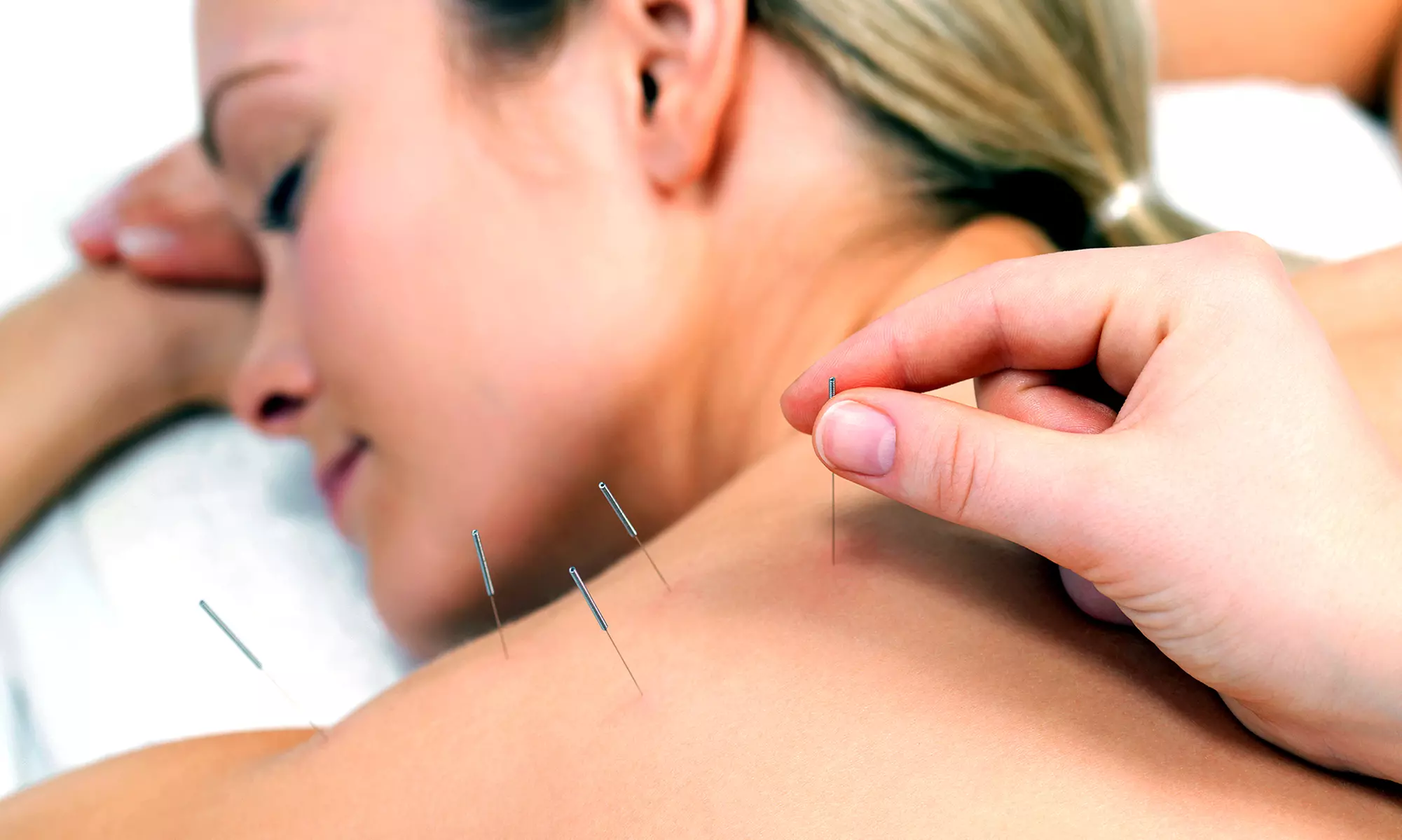 Three Acupuncture Treatments with Consultation from Kristina Katinka (69% Off) - Primary Image