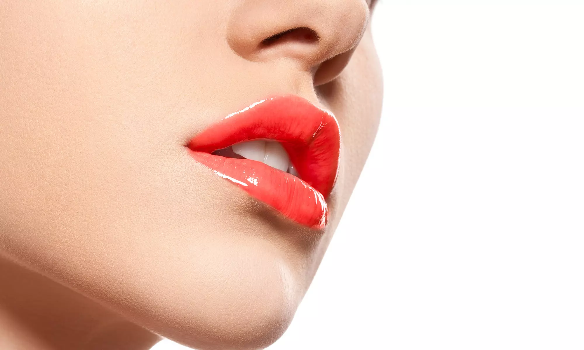 Infiltración de 1 vial de relleno en labios tipo "Russian lips"