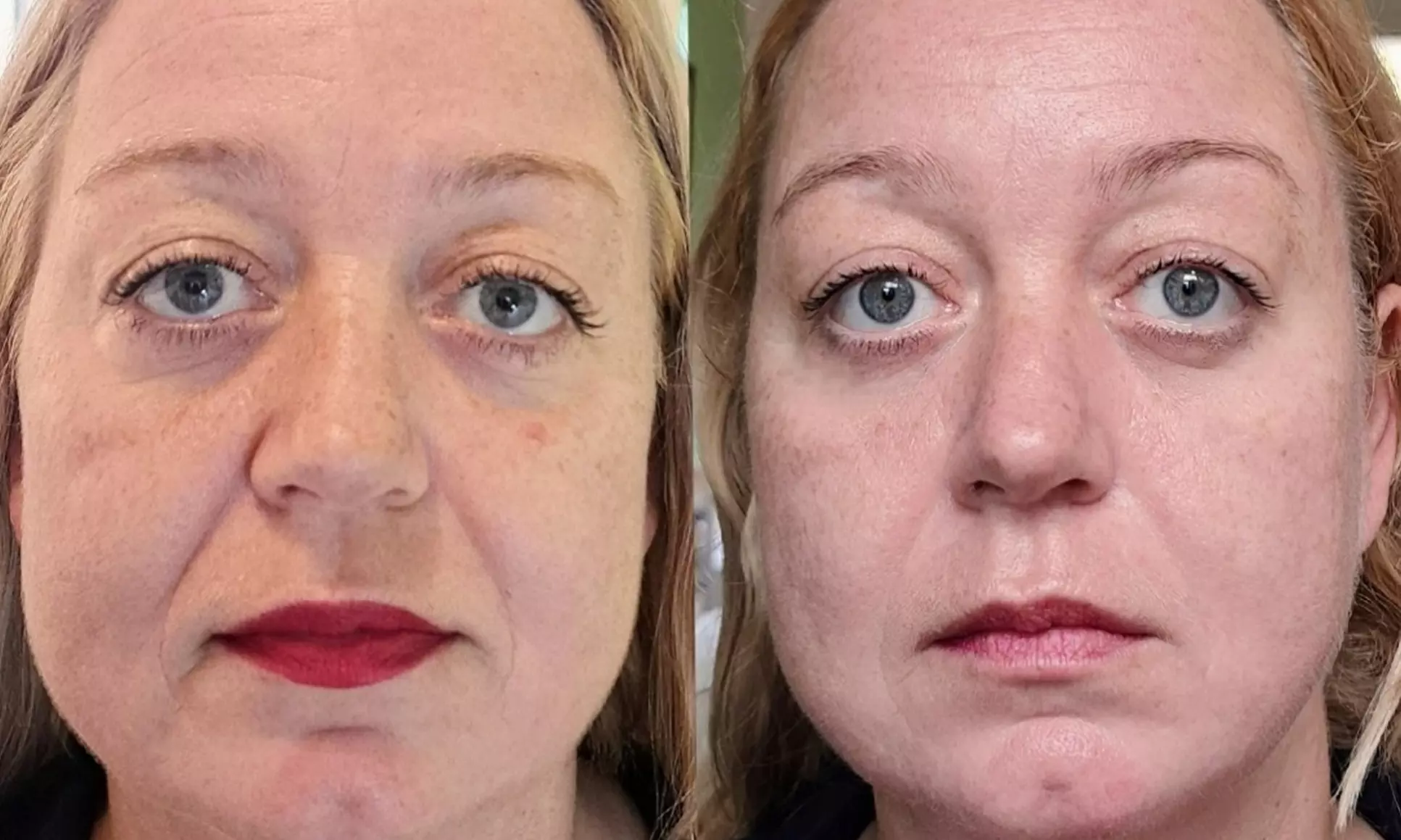 Recente HIFU 22D 2026 Facelift Zonder Snijden en gezichtsbehandeling